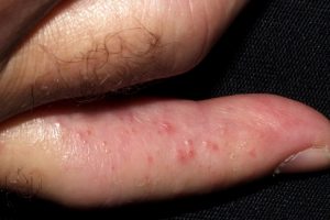 Dishidrosis vesiculas en la cara lateral de los dedos de las manos