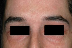 L20 Dermatitis atópica (blefaritis atópica); eczema crónico palpebral y en la frente