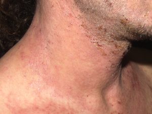 L20 Dermatitis atópica; placas de eczema subgudo (exudación y costras) y crónico (piel seca i liquenificada) en el cuello
