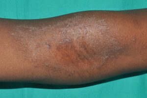 L20 Dermatitis atópica en una paciente de color; lesiones pruriginosas de eczema crónico con sequedad, pigmentación y liquenificación de la piel en el pliegue antecubital