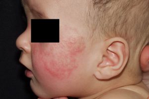 L20 Dermatitis atopica. Eczema subagudo en las mejillas