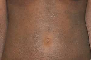 L20 Dermatitis atópica generalizada en un adolescente. Prurito intenso y liquenificación por rascado en tronco anterior y abdomen