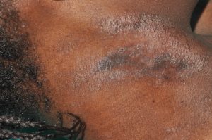 L20 Dermatitis atópica en un adolescente de color; lesiones pruriginosas de eczema crónico con sequedad, pigmentación y liquenificación de la piel en el cuello