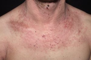 L20 Dermatitis atópica moderada del adulto; placas pruriginosas de eczema subagudo y crónico en cuello y V torácica