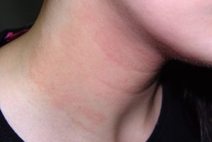 L20 Dermatitis atópica en un adolescente; placas de eczema crónico en el cuello