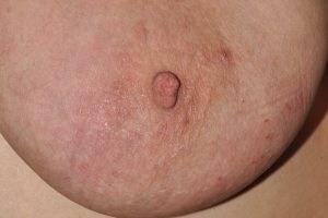 L20 Dermatitis atópica del adulto. Eczema del pezón y la areola