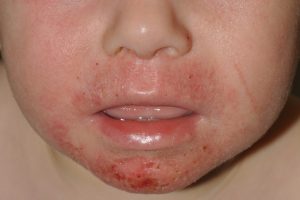 L20 Dermatitis atopica. Eczema perioral por chupeteo