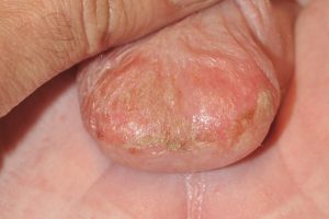 L22 Dermatitis del pañal; eritema y erosiones escroto; dermatitis de contacto irritativa por humedad i productos irritantes de la orina y las heces
