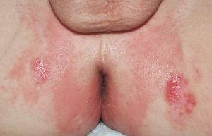 L22 Dermatitis del pañal; eritema y erosiones peranales; dermatitis de contacto irritativa por humedad i productos irritantes de la orina y las heces