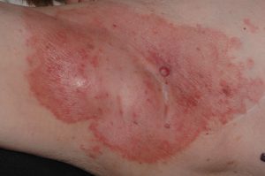 L24. Dermatitis irritativa de contacto aguda xilar; placa eritematosa bien delimitada tras la aplicación de un remedio casero