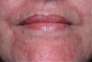 L24.0 Dermatitis irritativa de contacto; eritema y papulopústulas periorales por cosméticos
