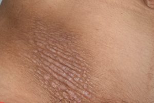 L28.0-009-Neurodermitis-Liquenificacion-en-fosa-iliaca-derecha-por-rascado-piel-gruesa-con-aumento-de-la-cuadricula-cutaneas-y-alguna-excoriacion-por-rascado.-Prurito-intenso