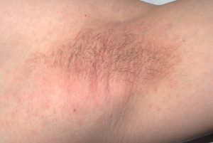 L28.0 Neurodermitis axilar; placa de eccema crónico y liquenificado (engrosamiento de la piel con aumento de la cuadrícula cutáneas) por rascado. Prurito intenso