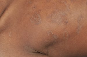 L30.0 Eczema numular en un paciente de color; placas pigmentadas y descamactivas en el tronco desde ha semanas