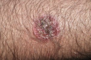 L30.0 Eczema numular; placa eczematosa y pruriginosa en forma de moneda, sin cambios desde hace 1 mes