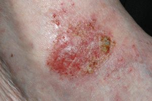 L30.0 Eczema numular; placa eritematosa con erosiones, exudación y escamocostras amarillentas en dorso del pie