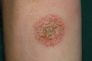 L30.0 Eczema numular; placa eritematosa con exudación y escamocostras en la pierna