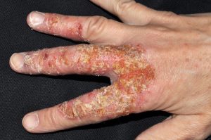 L30.0 Eeczema numular; placa eritematosa con erosiones, exudación y escamocostras amarillentas en dorso de la mano