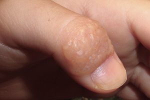 L30.1 Dishidrosis; Dermatitis vesiculosa, pruriginosa y recurrente en los dedos de las manos