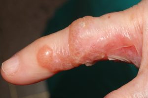 L30.1 Dishidrosis; brotes recidvantes de vesículas y ampollas multiloculares entre los dedos de las manos, sin relación con el trabajo