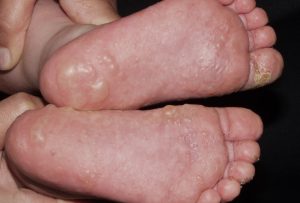 L30.1 Dishidrosis; dermatitis vesiculosa y ampollosa aguda en las plantas de los pies en un niño