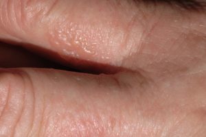 L30.1 Dishidrosis; dermatitis vesiculosa y pruriginosa entre los dedos de las manos sin relación con alergenos