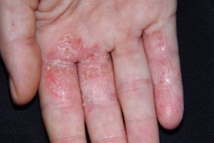 L30.1 Dishidrosis en fase subaguda; dermatitis pruriginosa y recurrente de las manos y pies con placas eritematodescamativas, exudativas y escamocostrosas