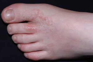 L30.1 Dishidrosis en fase subaguda; dermatitis pruriginosa y recurrente de las manos y pies con placas eritematodescamativas, exudativas y escamocostrosas