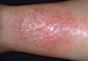 L30.81 Eczema craquelé; fase subaguda; piel fisurada que forma figuras craqueladas, con exudación