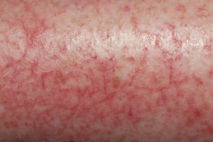 L30.81 Eczema-craquele; piel seca y agrietada que forma figuras craqueladas con escamocostras