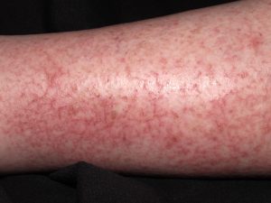L30.81 Eczema-craquele; piel seca y agrietada que forma figuras craqueladas con escamocostras