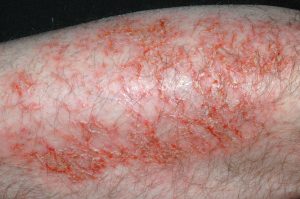 L30.81 Eczema craquelé; piel seca y agrietada que forma figuras craqueladas, con exudación y escamocostras