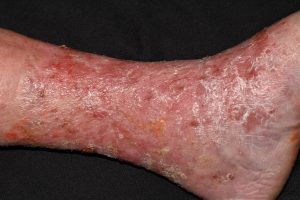 I83.1 Dermatitis venosa; placa eritematosa en tercio distal de miembros inferiores con descamacion y prurito en paciente con signos de insuficiencia venosa
