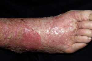 I83.1 Dermatitis de estasis o eczema varicoso sobreinfectado placa eritematosa exudativa con erosiones descamacion y escamocostras amarillentas