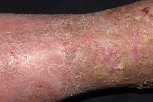 I83.1 Dermatitis de estasis o venosa sobreinfectada; placa eritematosa, descamativas y exudativas en tercio distal de la pierna sin nodulos ni fiebre
