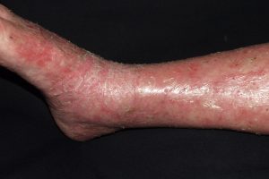 I83.1 Dermatitis venosa; placa eritematosa en tercio distal de miembros inferiores con descamacion y prurito en paciente con signos de insuficiencia venosa
