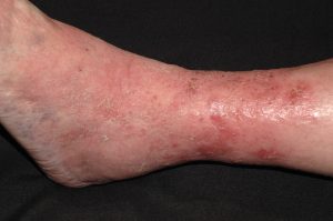 I83.1 Dermatitis venosa; placa eritematosa en tercio distal de miembros inferiores con descamacion y prurito en paciente con signos de insuficiencia venosa