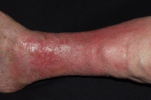 I83.1 Dermatitis venosa; placa eritematosa en tercio distal de miembros inferiores con descamacion y prurito en paciente con signos de insuficiencia venosa
