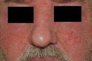 L23 006 Dermatitis alergica de contacto por bálsamo del Perú (cremas cicatrizantes); eritema, edema, erosiones, exudación y costras amarillentas