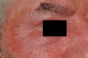 L23 007 Dermatitis alérgica de contacto por bálsamo del Peru (cosmético); fase aguda; eritema y edema intesos con discreta eliminación de líquido