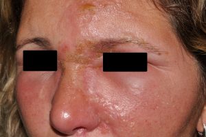 L23 Dermatitis alérgica de contacto aguda a crema de aciclovir; eritema, edema y ampollas en la región periocular izq y la mejilla
