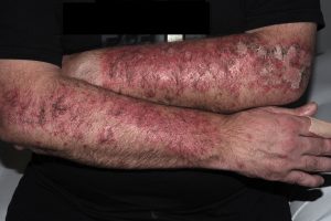 L56.0 Reacción fototóxica por tetraciclinas; eritema y costras en zonas fotoexpuestas