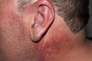 L56.0 Reacción fototóxica por tetraciclinas; eritema y costras en zonas fotoexpuestas