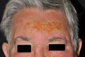 L56.1 Dermatitis fotoalérgica a la benzofenona de un fotoprotector; eczema subagudo (ertema, prurito, exudación y costras amarillentas) respetando el borde del pelo y los párpados superiores