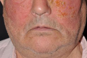 L56.1 Dermatitis fotoalérgica a la benzofenona de un fotoprotector; eczema subagudo (ertema, prurito, exudación y costras amarillentas) respetando el borde del pelo y los párpados superiores