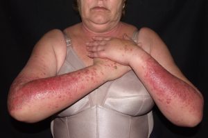 L56.1 Fotoalergia por prometacina; eczema subagudo y pruriginoso en zonas fotoexpuestas de los brazos, respetando la cara interna de los mismos