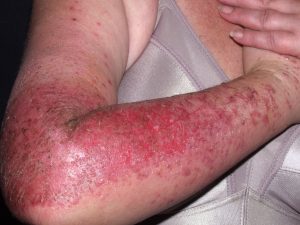L56.1 Fotoalergia por prometacina; eczema subagudo y pruriginoso en zonas fotoexpuestas de los brazos, respetando la cara interna de los mismos