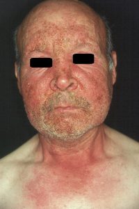 L56.1 Fotoalergia por tiacidas; prurito y eczema subagudo con exudación y costras amarillentas en la cara y la V torácica