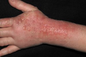 L56.1 Fotoalergica por una pomada de antiinflamatorios no esteroideos (piroxicam, fotoalergia); fase aguda; eritema y edema intensos con vesículas y ampollas para dolor de la muñeca
