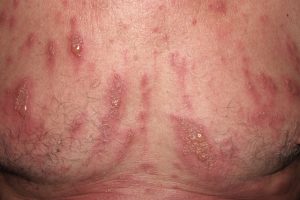 L57.8 002 Fitofotodermatitis; placas eritematoedematosas con vesículas y ampollas que siguen trayactos lineales